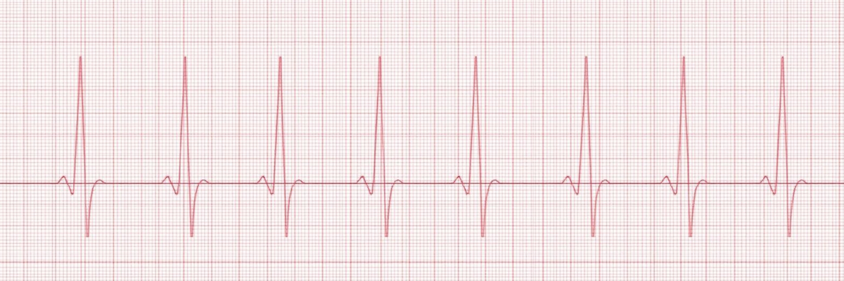 What Does Bradycardia Mean for a Newborn in the NICU?