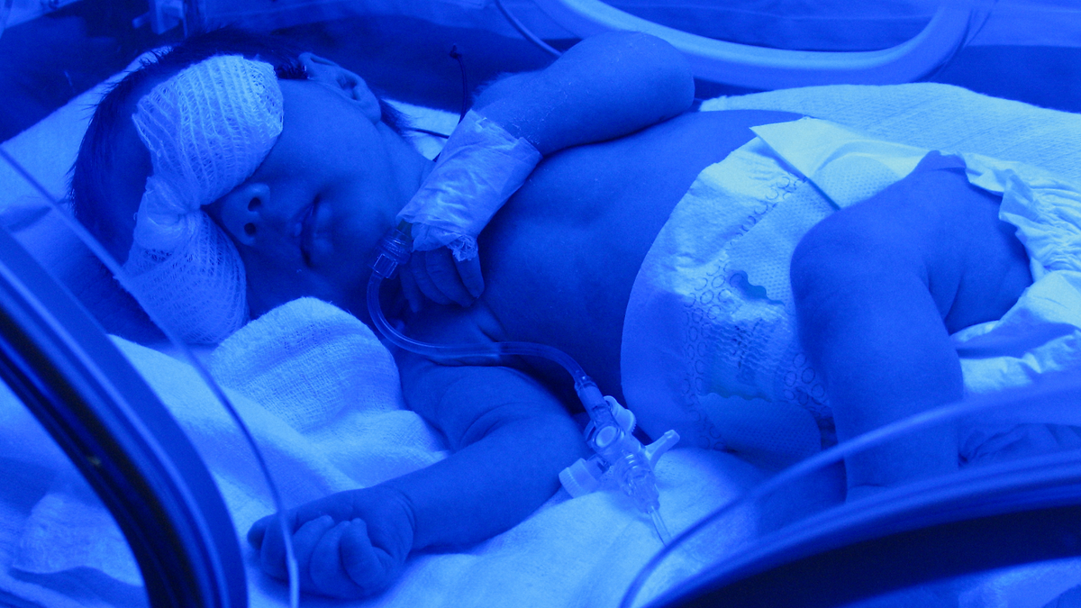 nicu setback, bilirubin, jaundice, light therapy, nicu
